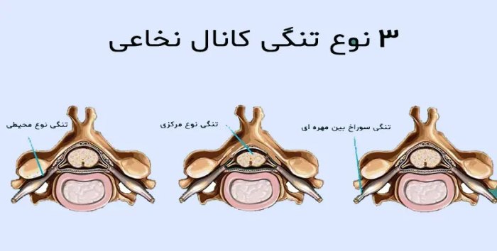 انواع تنگی فورامینال