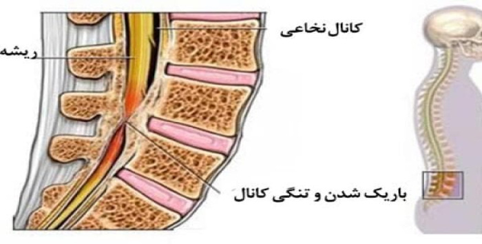 باریک شدن دوفورامینال