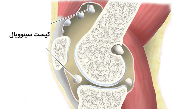 کیست سینوویال