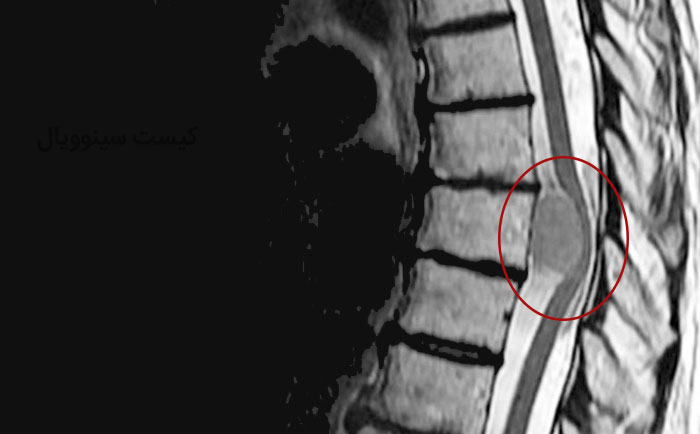 روش‌ های تشخیص کیست در نخاع
