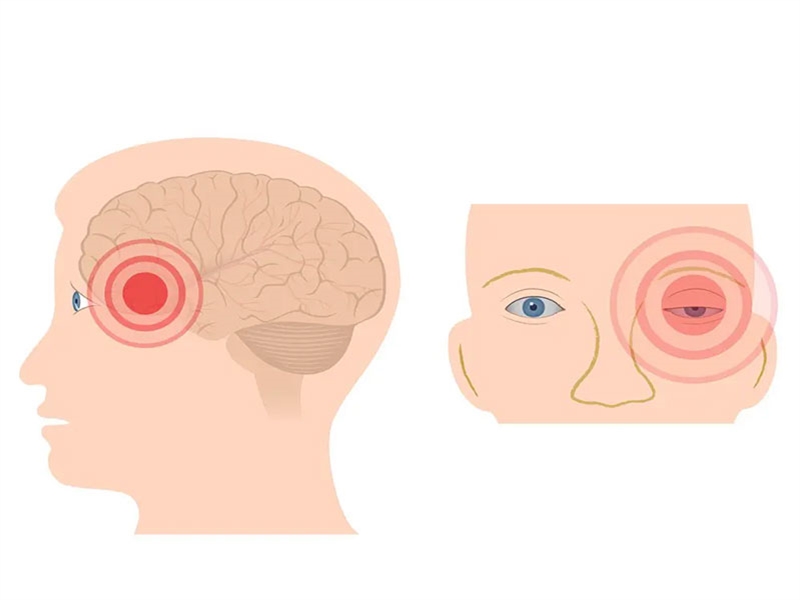 علائم سردرد خوشه ای چیست؟ روش های درمان